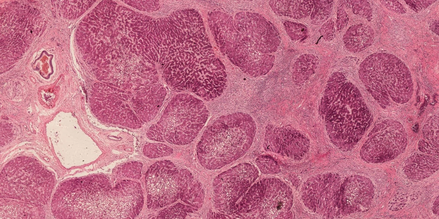 Identifying the Signs of Liver Disease: How Alcohol Affects Your Liver