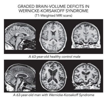 NIAAA_brain_wernicke_korsakoff_images