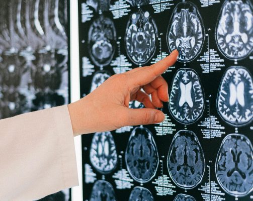 doctor pointing to the regions of the brains where cravings derive from