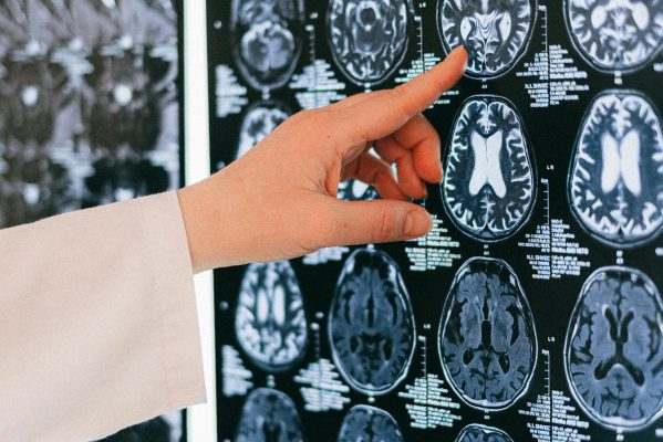 doctor pointing to the regions of the brains where cravings derive from